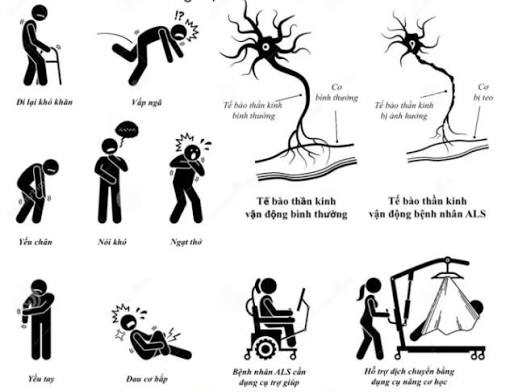 Bệnh Xơ Cứng Teo Cơ (ALS): Dấu Hiệu, Chi Phí Điều Trị & Giải Pháp Bảo Hiểm