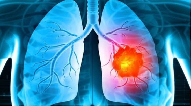 Ung Thư Phổi: Triệu Chứng, Chi Phí Điều Trị và Giải Pháp Bảo Hiểm Bệnh Hiểm Nghèo