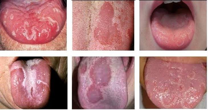 Ung Thư Lưỡi: Triệu Chứng, Chi Phí và Giải Pháp Bảo Hiểm Tài Chính